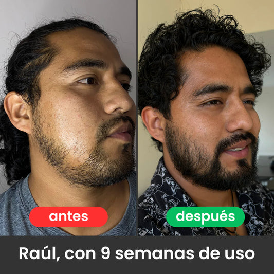 Bálsamo para Crecimiento de Barba Ultra Potente con Minoxidil 20% | 100mL